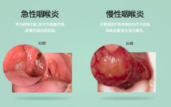 慢性咽炎是怎么得的，该怎么办呢?