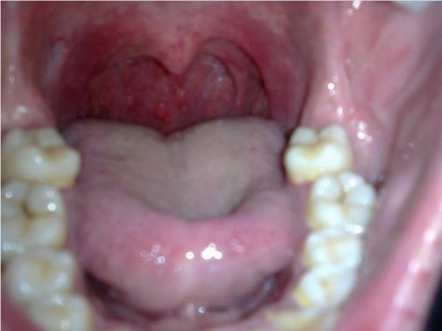 5,舌根运动法治咽喉炎   咽喉炎致使咽喉肿痛,嗓子燥痒,吞咽有异物