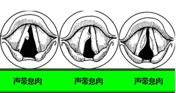 声带息肉不手术行吗？