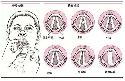 声带息肉的病因、症状和治疗问题介绍