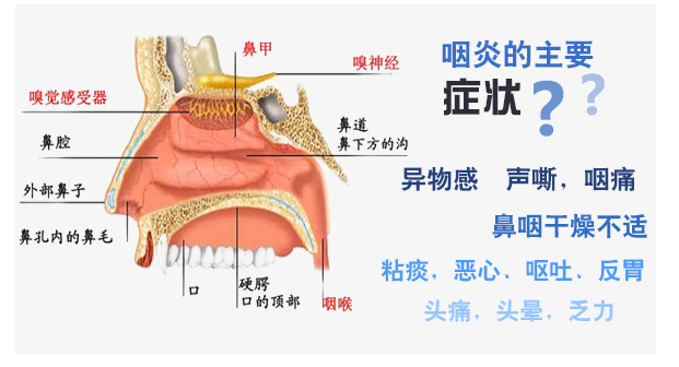 咽炎的症状表现