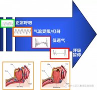 重庆仁品分享什么是睡眠呼吸暂停低通气综合征？