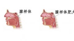 儿童腺样体肥大是怎么回事？