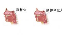重庆耳鼻喉科医院-腺样体肥大对儿童有哪些危害