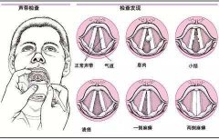 重庆仁品耳鼻喉医院-如何缓解声带息肉的症状