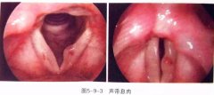 声带息肉病人的护理，值得一读！