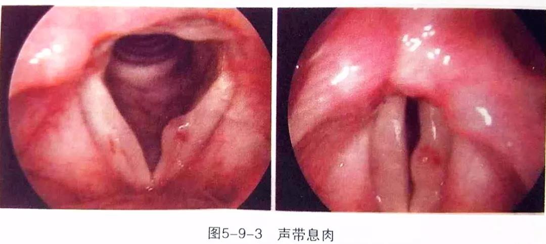 声带息肉的护理方法