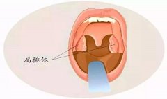 重庆耳鼻喉科医院_扁桃体炎的危害