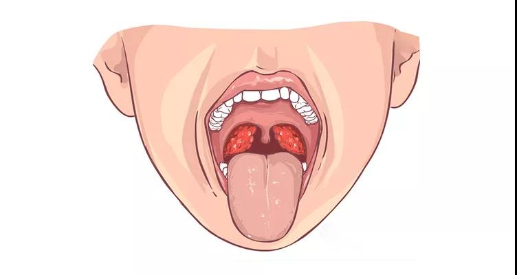 预防扁桃体炎的方法