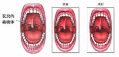 重庆如何预防扁桃体发炎