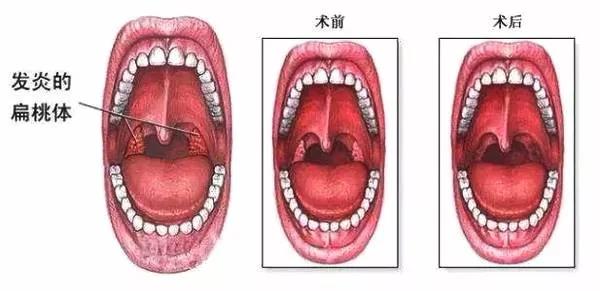 重庆扁桃体炎的预防方法