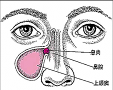 鼻息肉的常见预防方法？
