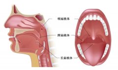 扁桃体发炎要不要割？主要看这几种情况