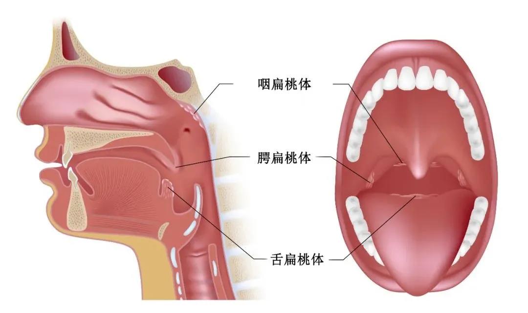 扁桃体炎