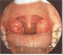 咽喉疼痛？别忽视扁桃体周脓肿！