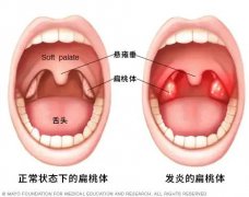 孩子的扁桃体怎么老发炎？忍一忍还是割