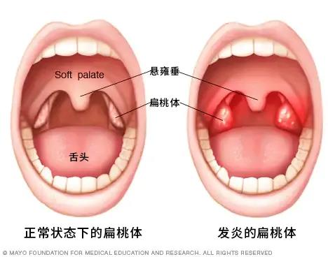 扁桃体炎