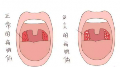 扁桃体发炎危害大吗？日常如何保护扁桃体不发炎