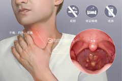 慢性咽炎反复发作是什么原因？