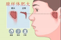 娃睡觉张嘴？越长越丑？腺样体肥大没跑了