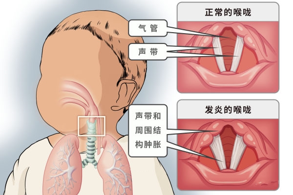 咽喉炎