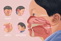 重庆看腺样体肥大的医院