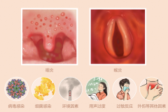 重庆看咽喉炎哪个医院好，咽喉炎症状及表现