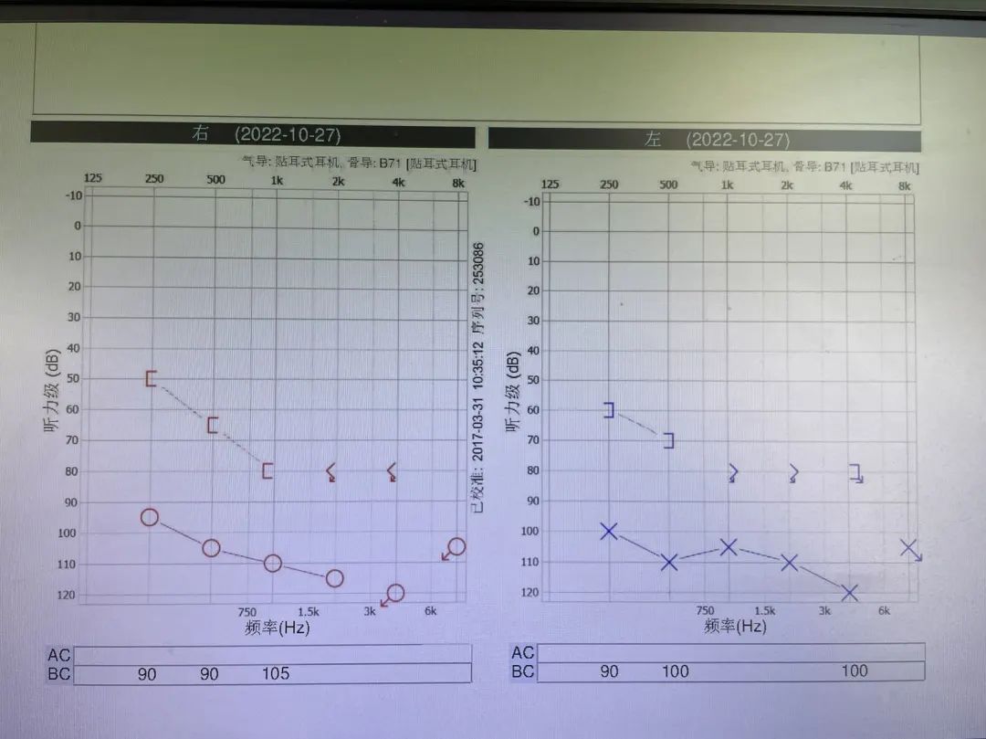听力检测报告